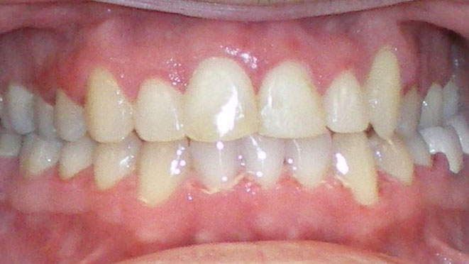 Rhodes Ranch Invisalign, Invisible Braces in Rhodes Ranch